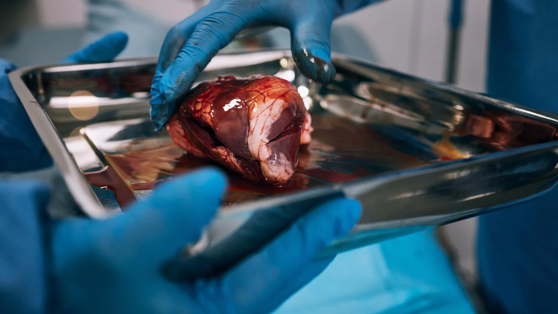 Many kidney transplant referrals stall before evaluation, study finds