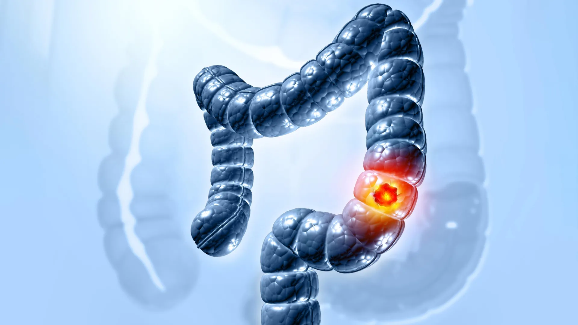 Gut toxin’s route into colon cells identified in cancer-linked study