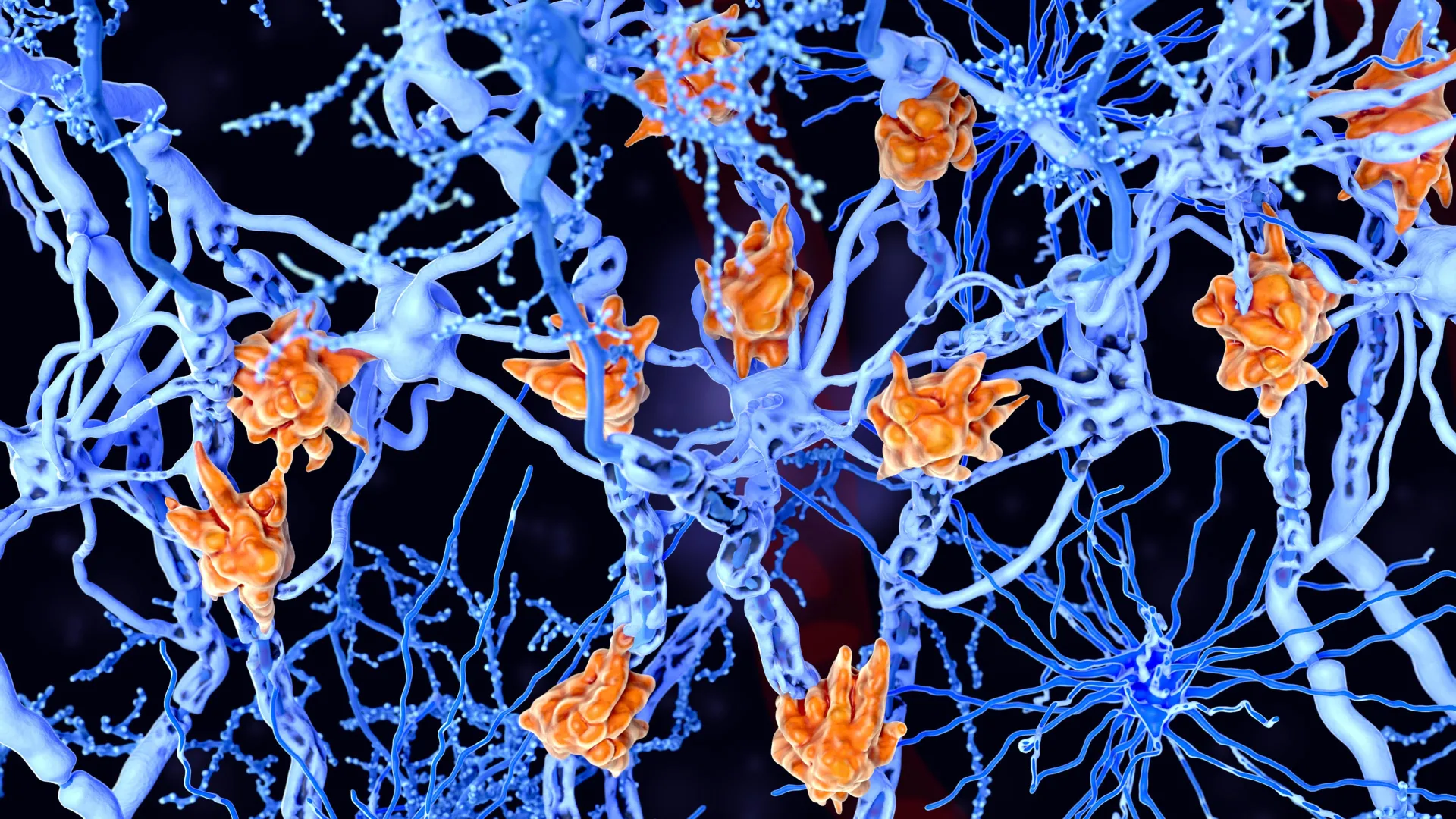 Fat-loaded immune cells linked to faster MS progression