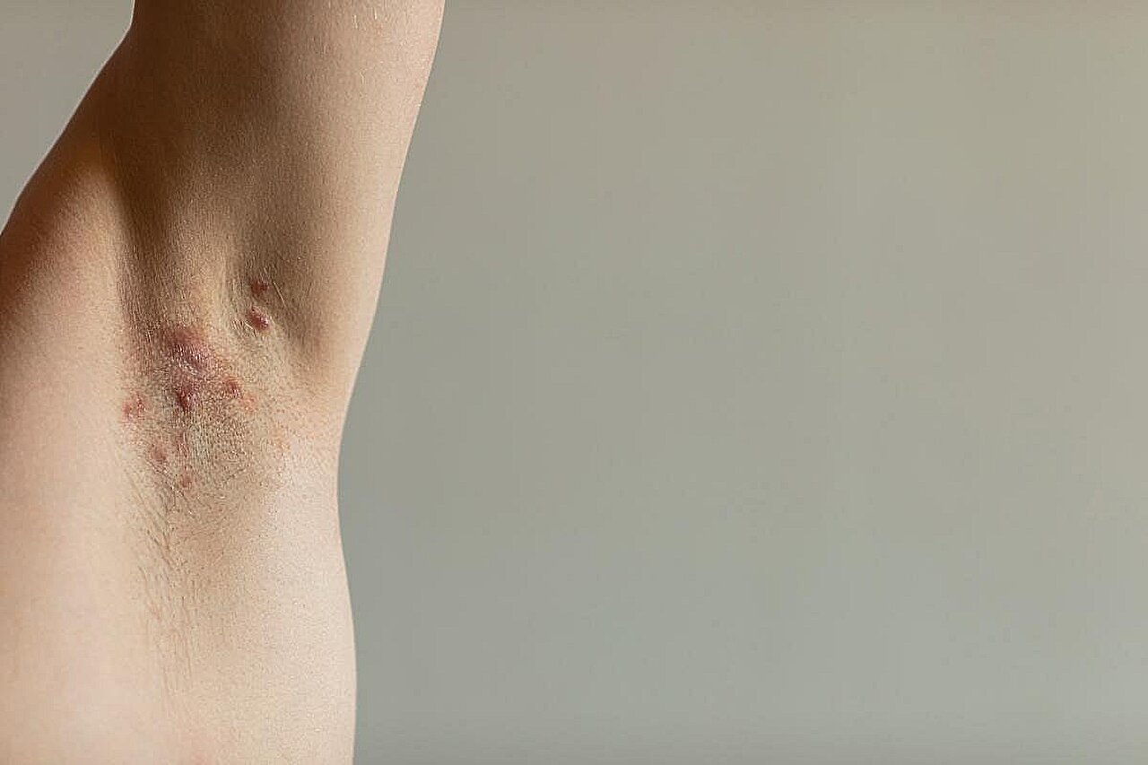 Povorcitinib hidradenitis suppurativa trial meets main goals