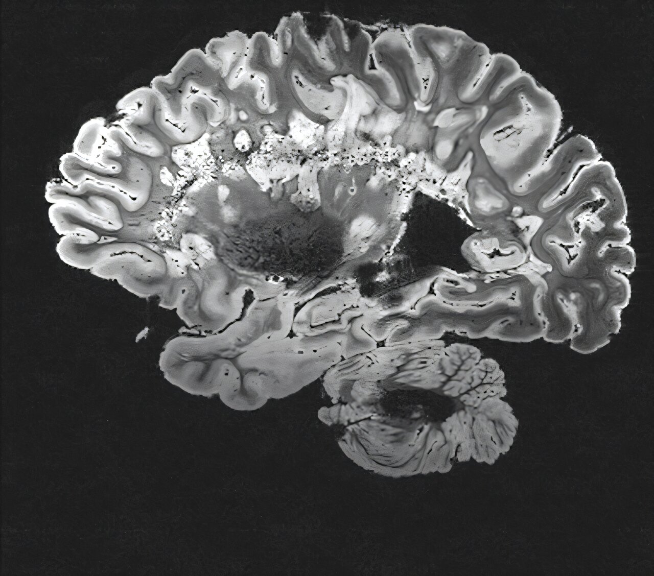 MRI study links NMOSD to brain shrinkage between relapses