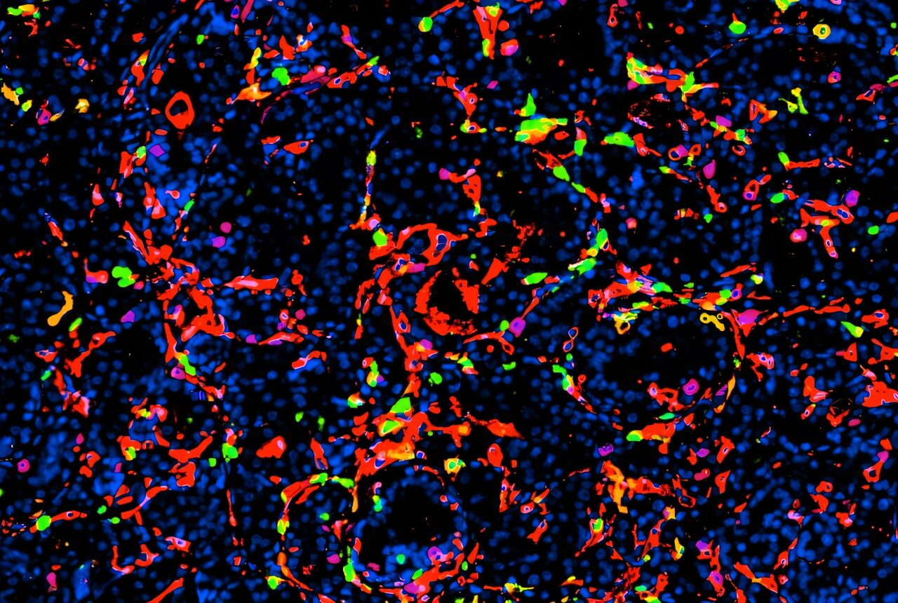 Silica nanoparticles spur prostate tumor remissions in mice