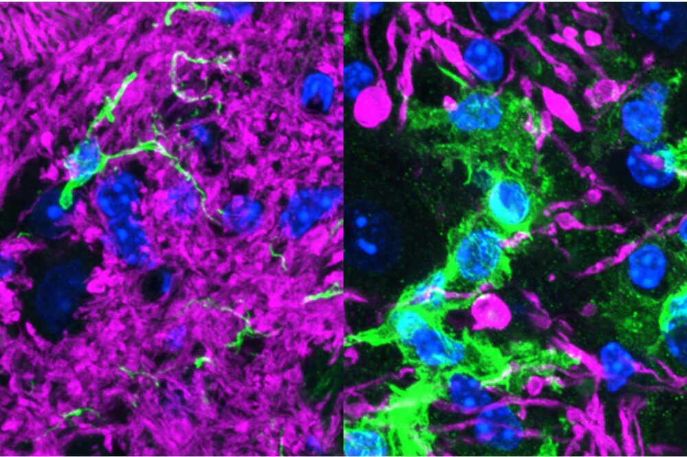 PSMF1 mutations tied to severe neurological disease