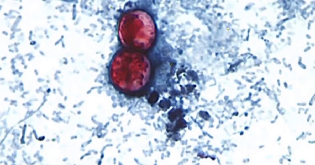 Cyclospora outbreak budget cuts questions reach federal response