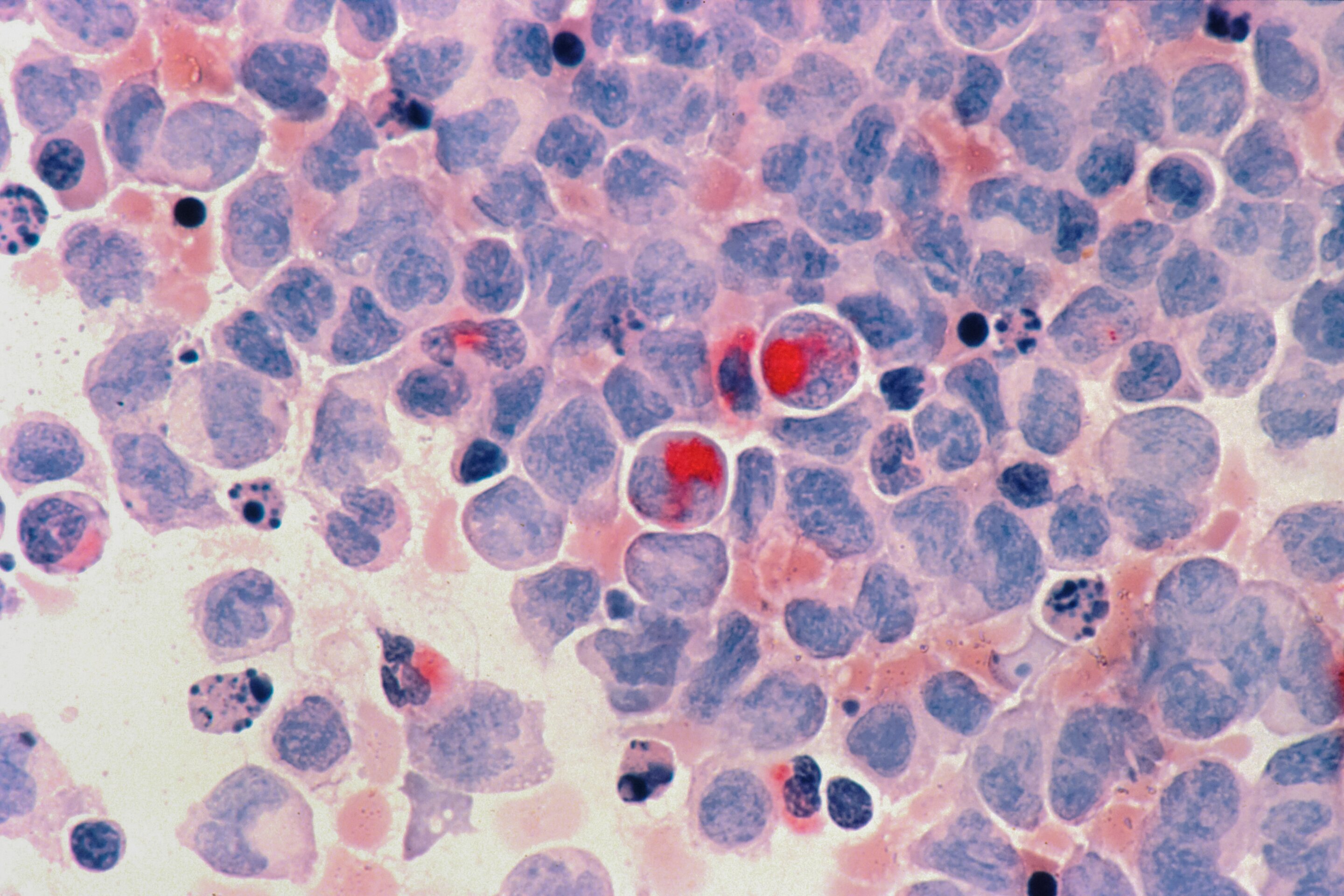Transmissible cancer in humans remains unsupported after catfish finding