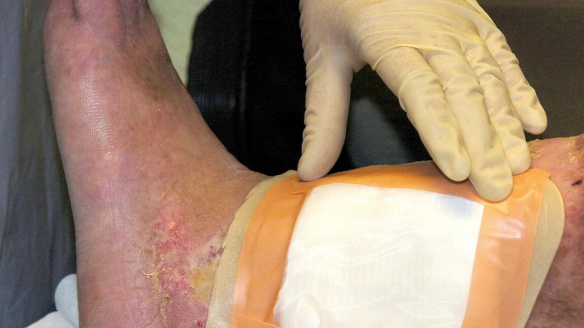 FDA clearance gives maggot wound therapy a second fly species