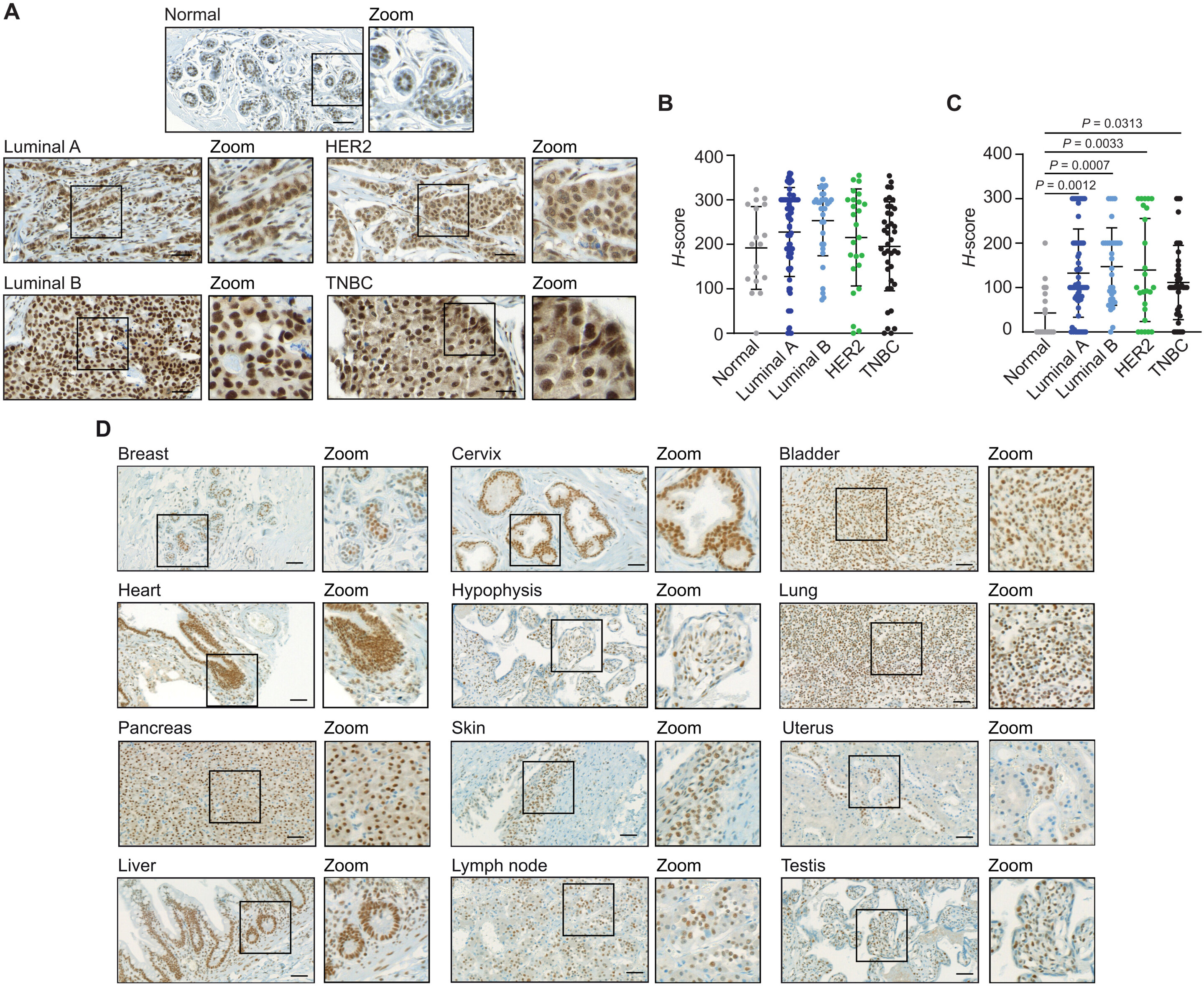 Study identifies METTL3 role in breast cancer spread