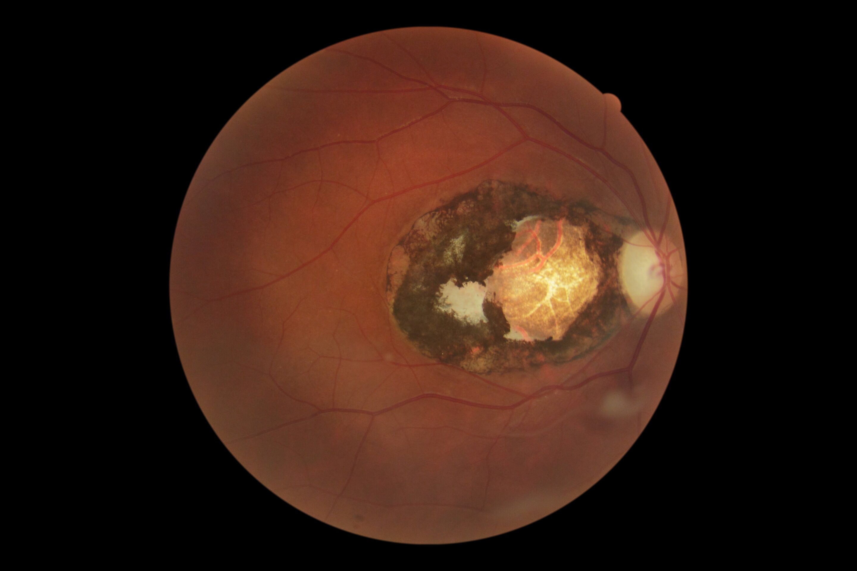 Researchers urge WHO to recognize toxoplasmosis as neglected disease