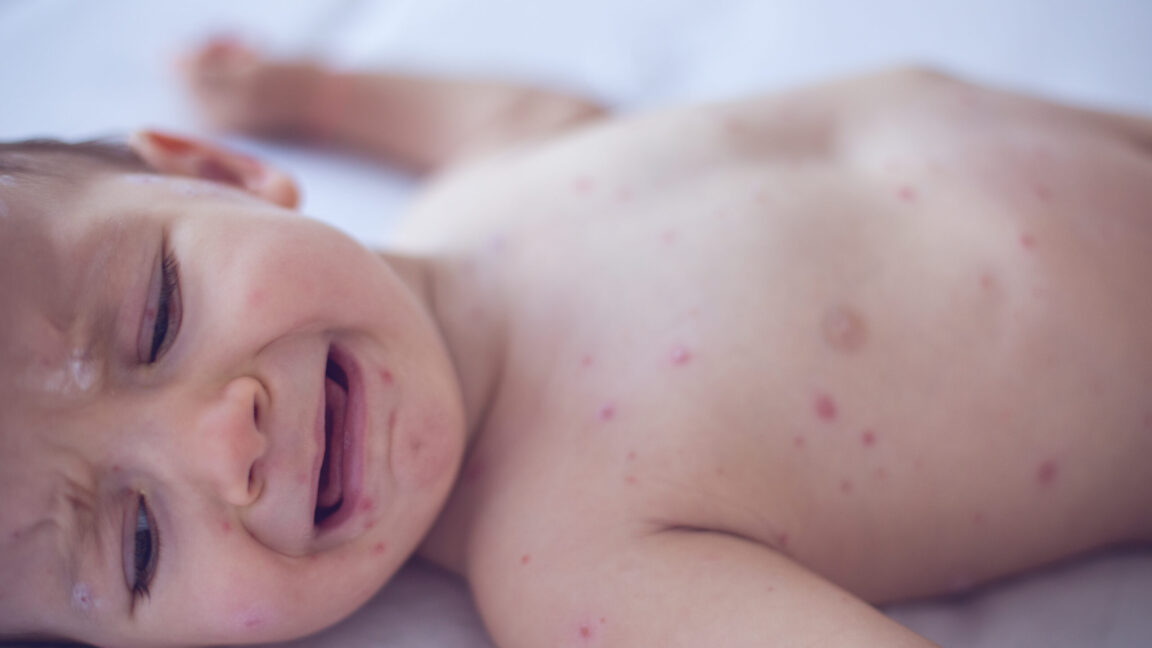 Pennsylvania infant measles death confirmed by Lancaster County coroner