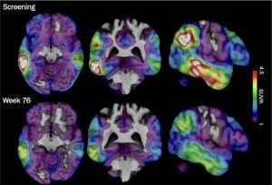 Experimental Alzheimer’s drug shows signs of slowing decline