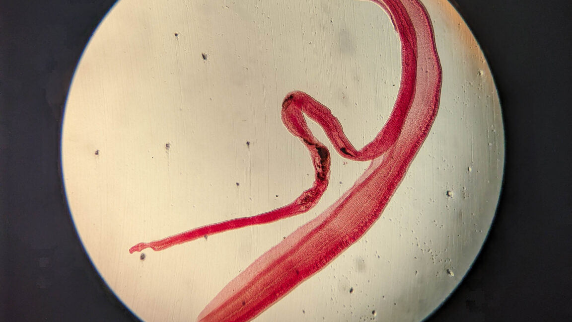 Cerebral schistosomiasis diagnosed in Philippine woman after antibody test
