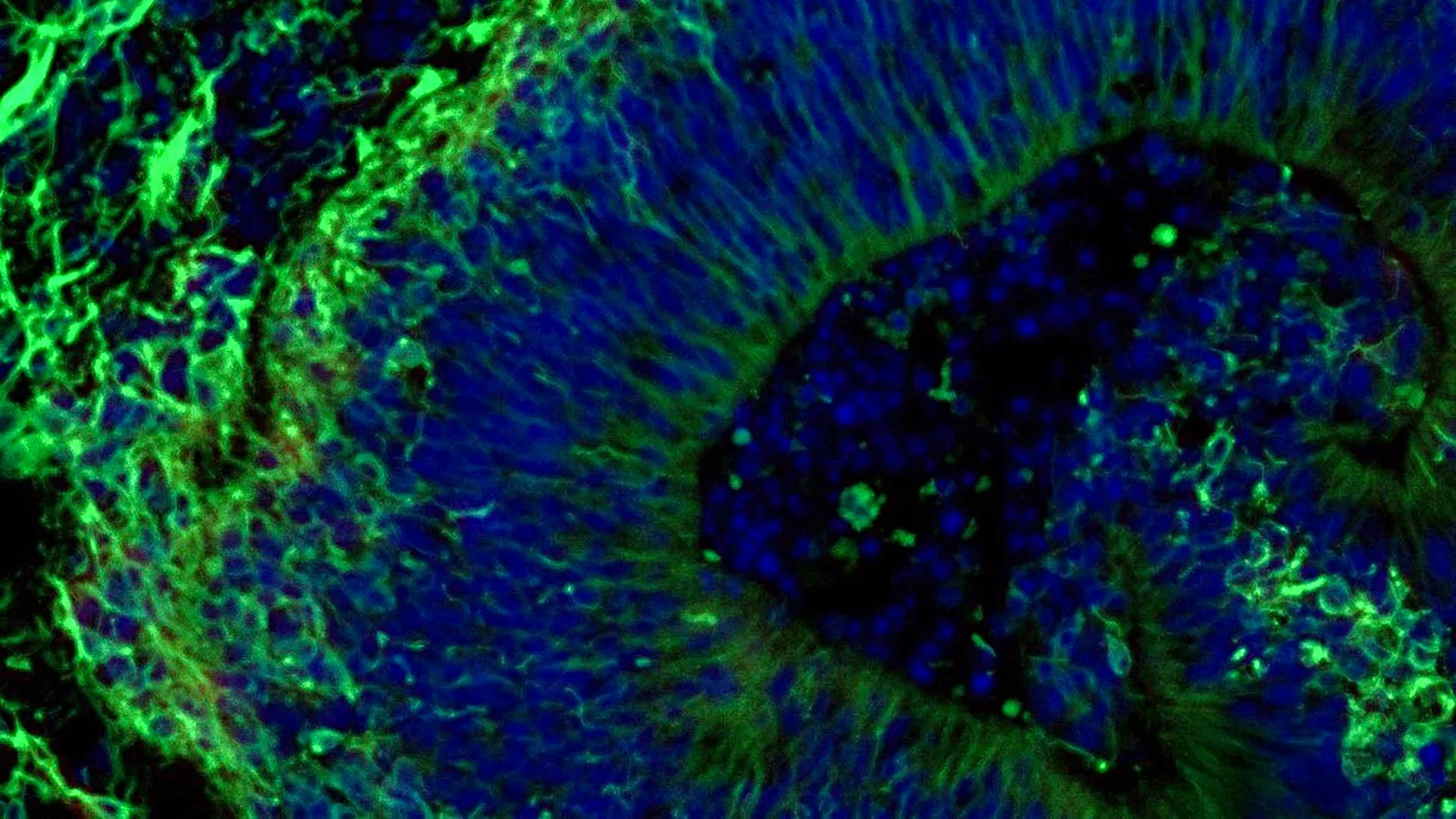 Mini brain models show varied Alzheimer’s drug responses