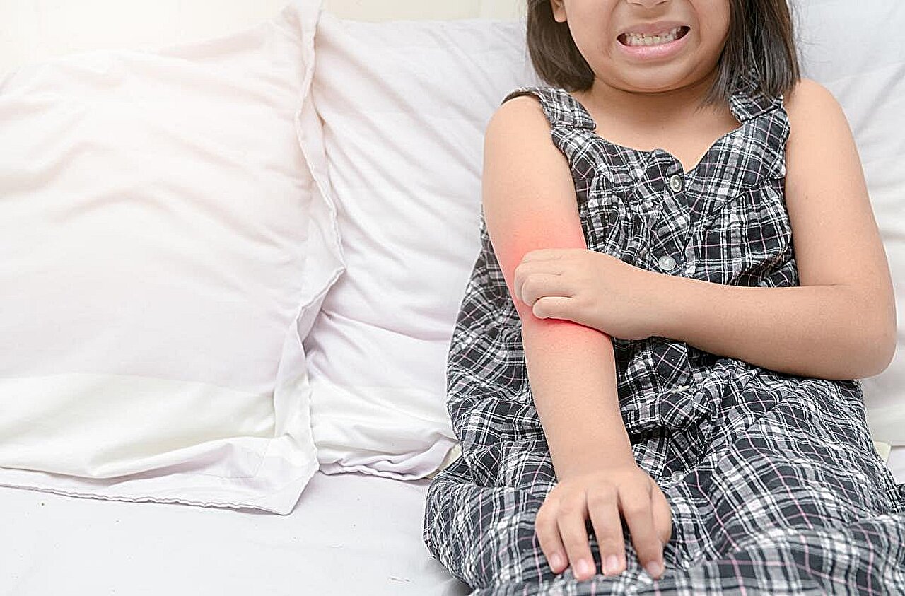 Atopic dermatitis mental health risks may be higher in youth