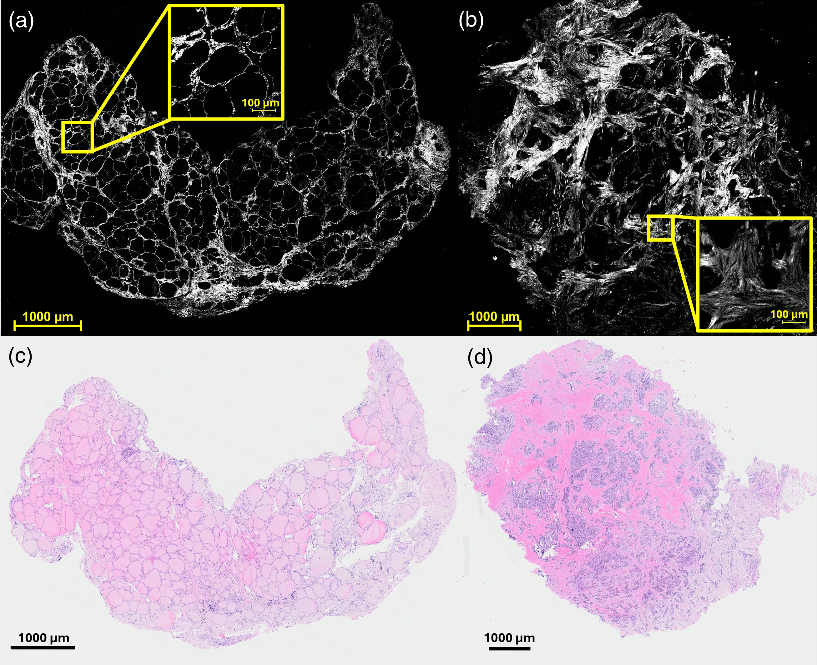 Light microscopy study aims to sharpen thyroid cancer diagnosis