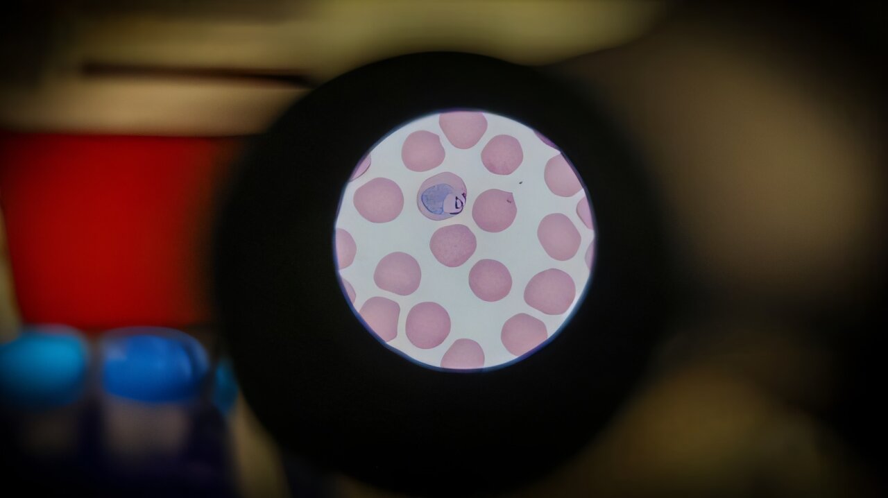 Shared liver-stage malaria markers point to T-cell vaccine path