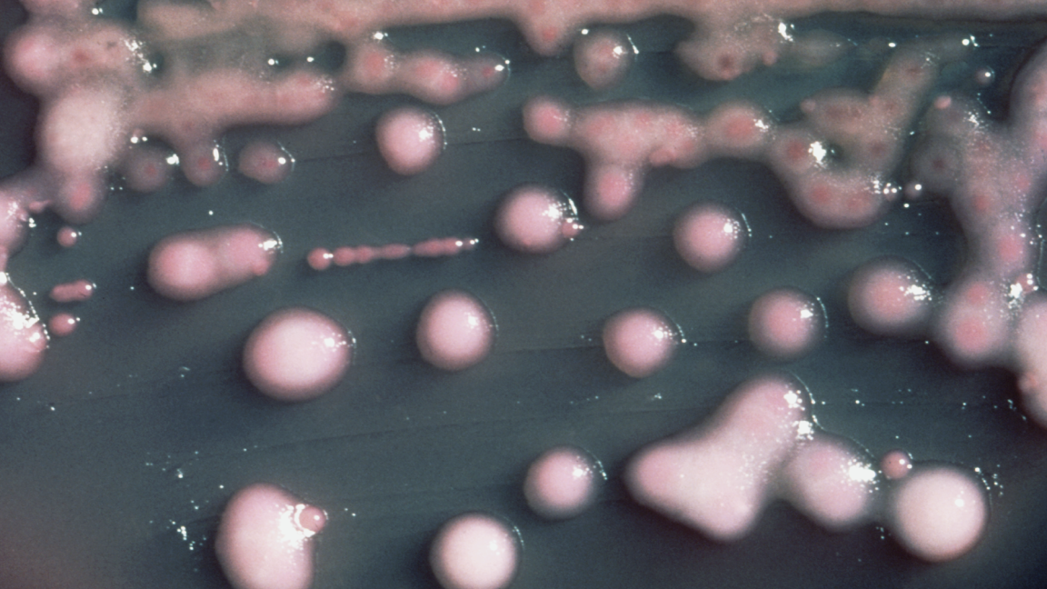 Klebsiella brain abscess traced to evolved UTI bacteria in case report