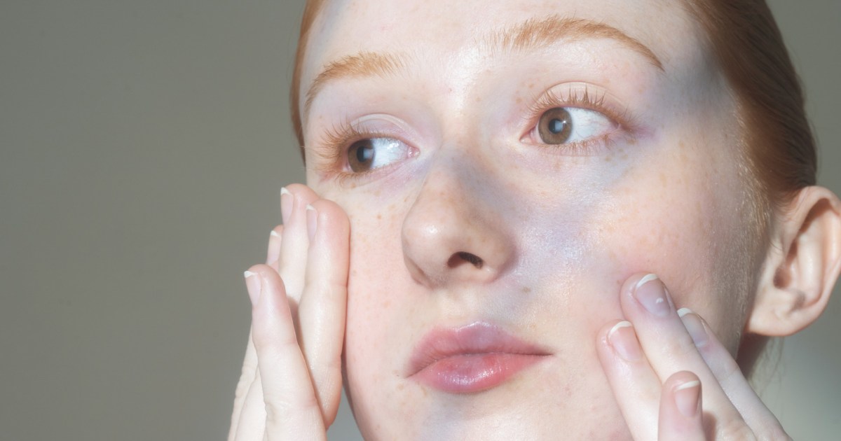 Dermatologists point teens to retinoids, benzoyl peroxide for acne care