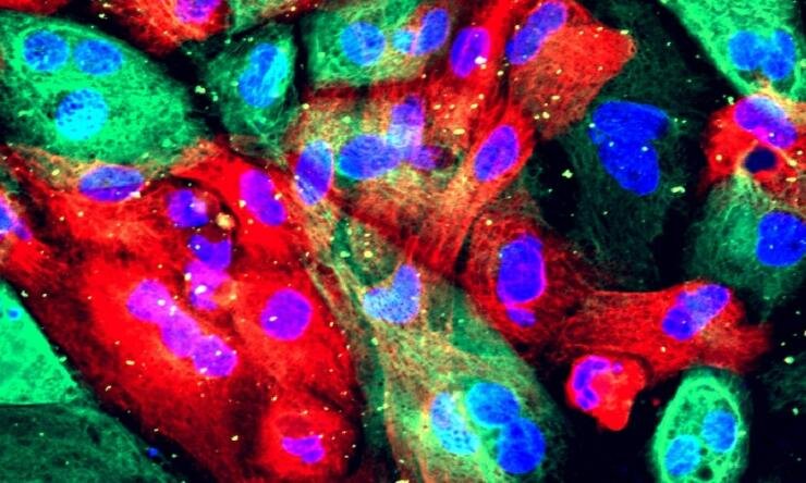 Gene changes may predict prostate cancer response to ferroptosis drugs