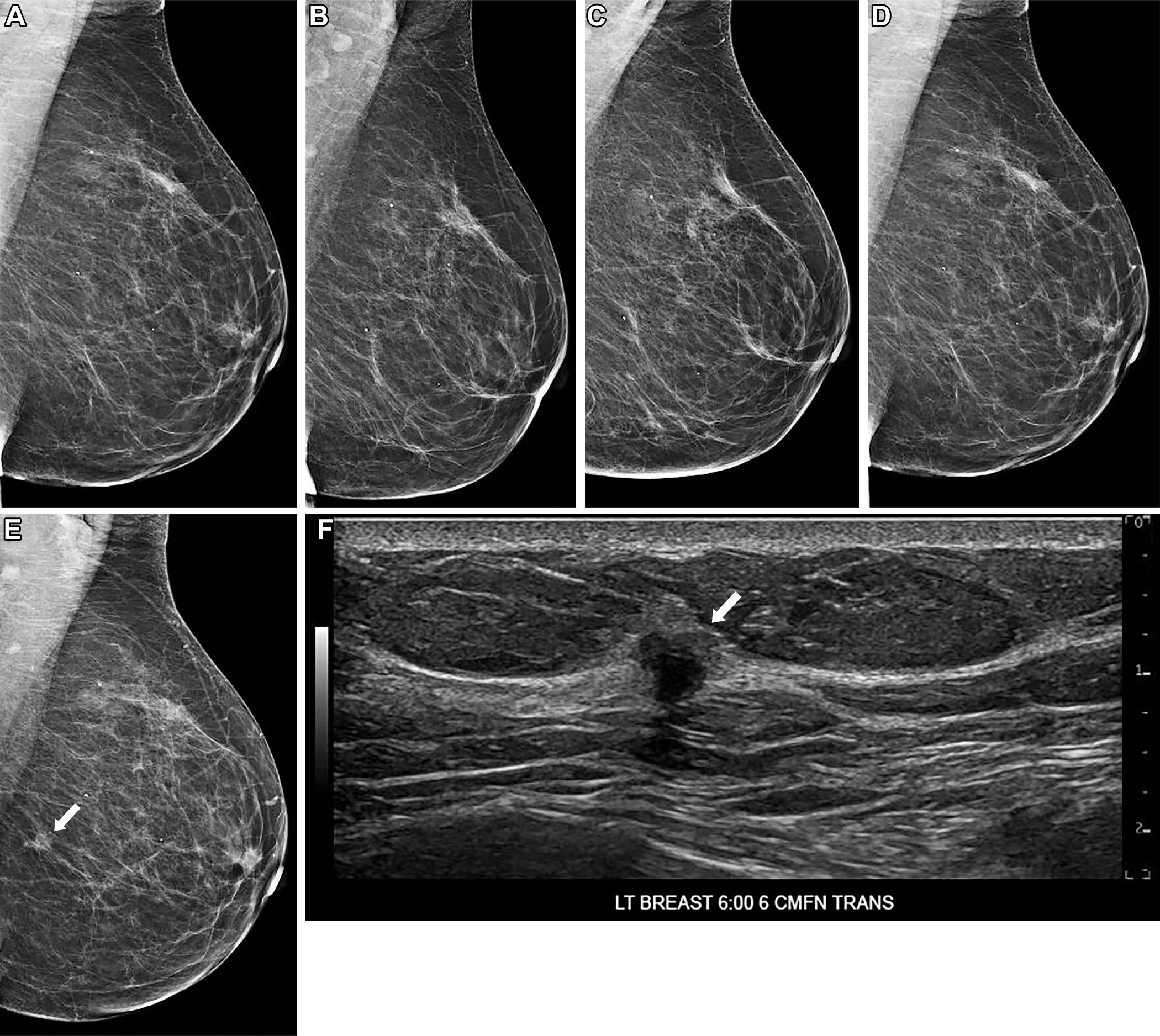AI mammogram risk trends may help predict breast cancer years ahead