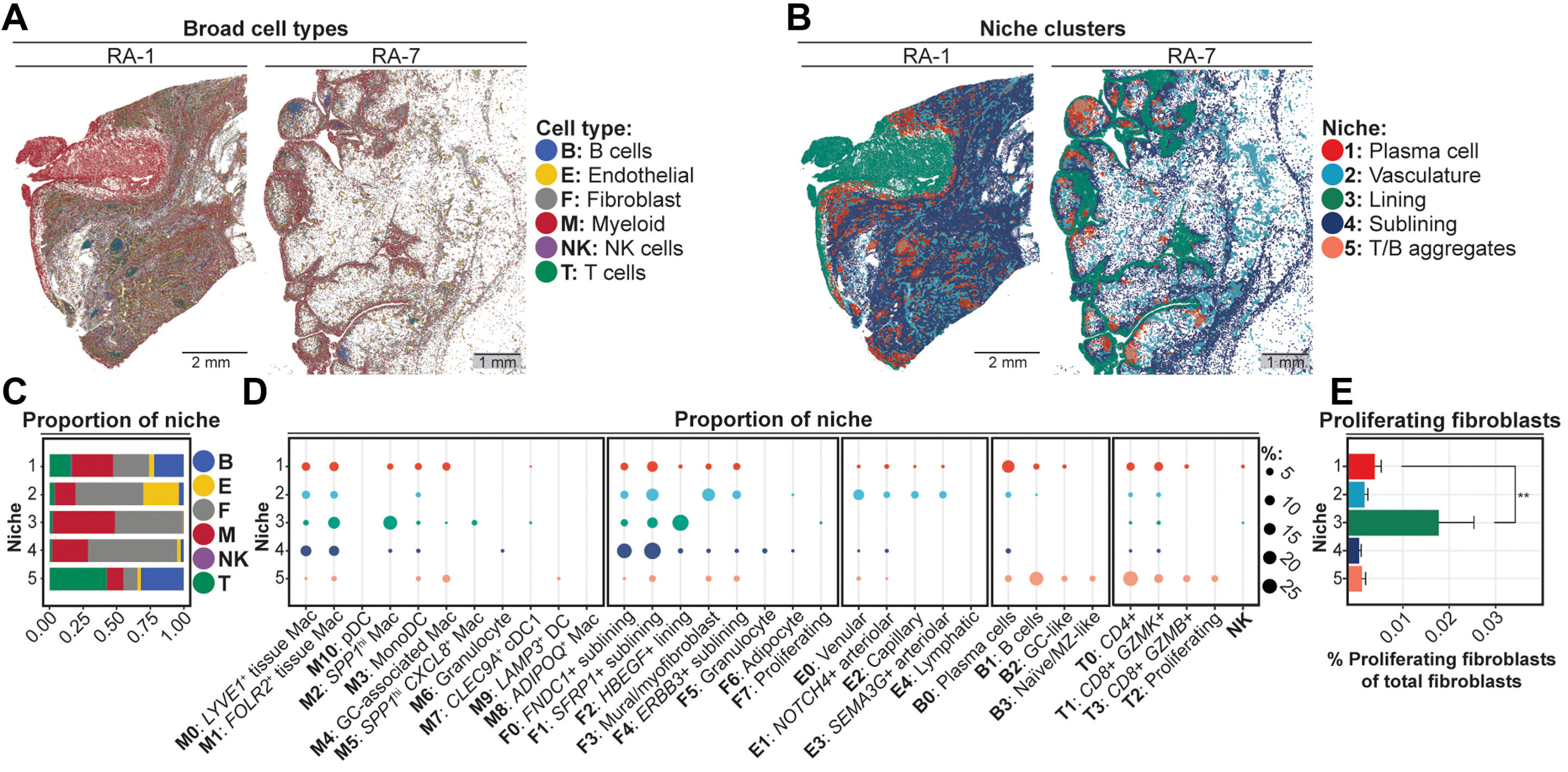 Immune cell niche tied to joint tissue overgrowth in rheumatoid arthritis