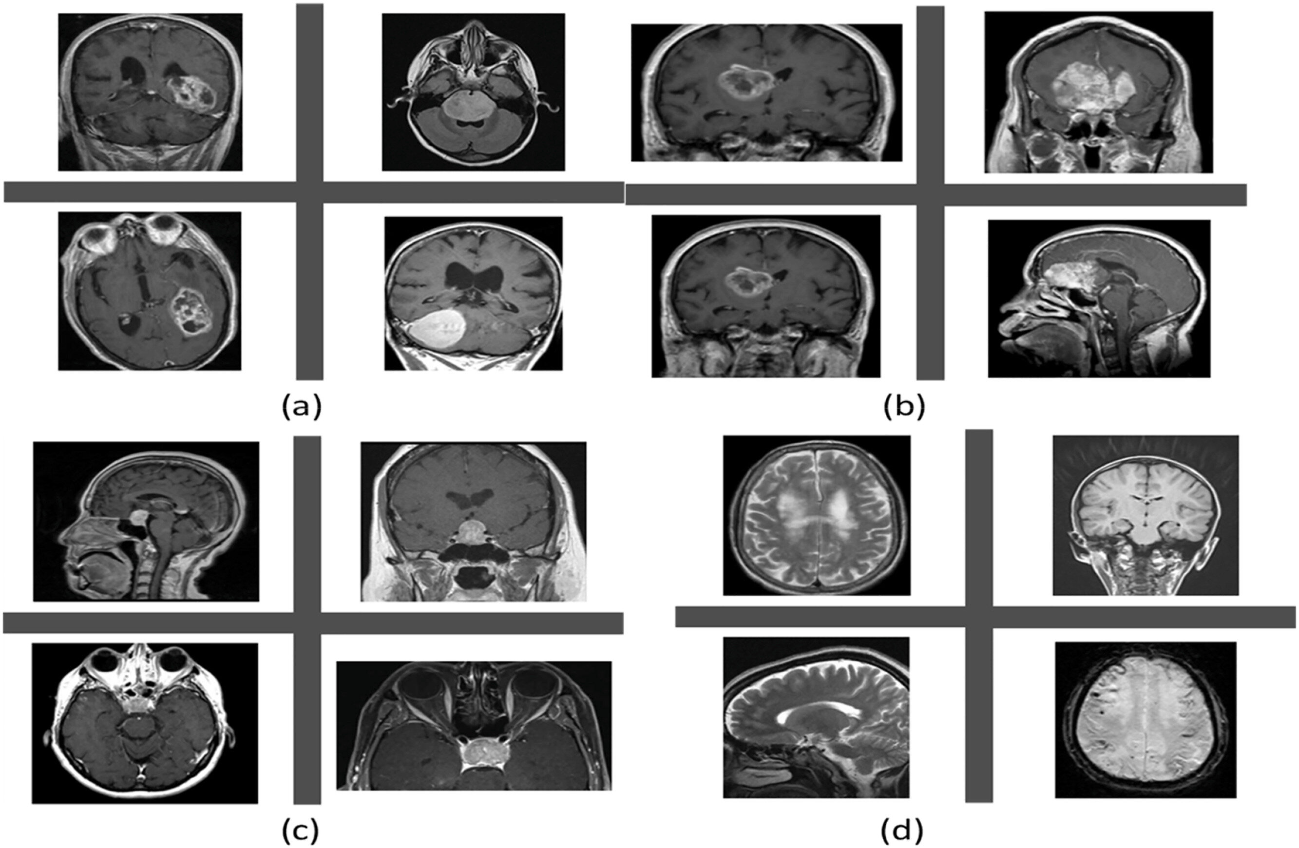 AI brain tumor MRI system detects scans, then classifies tumor type