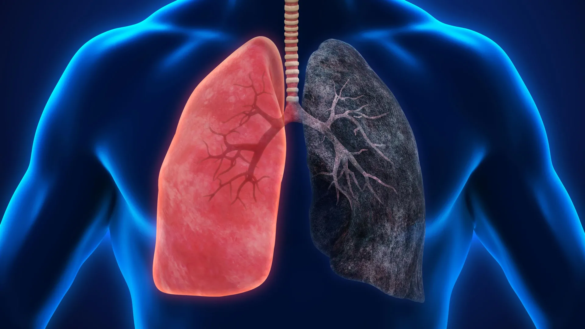 Heavy cannabis smoking tied to higher cancer risk in USC studies