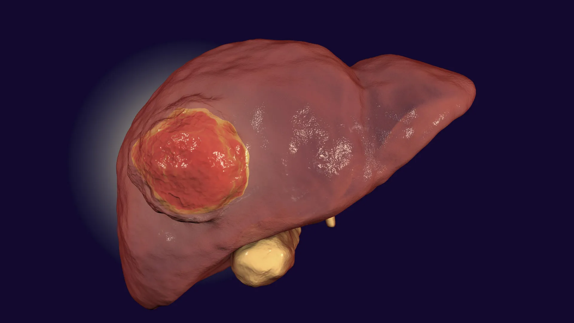 Approved drug boosts immunotherapy response in rare liver cancer samples