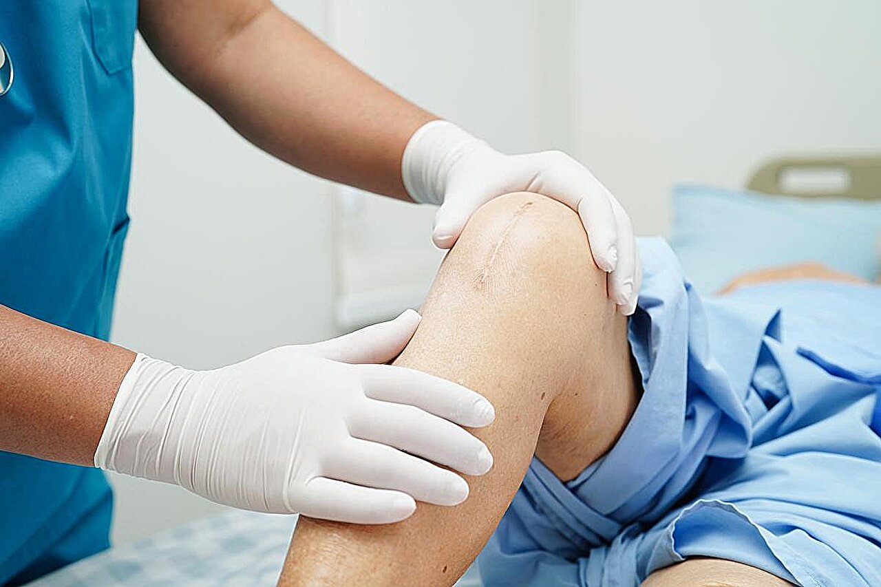 Crohn disease joint infection risk rises after arthroplasty, study finds