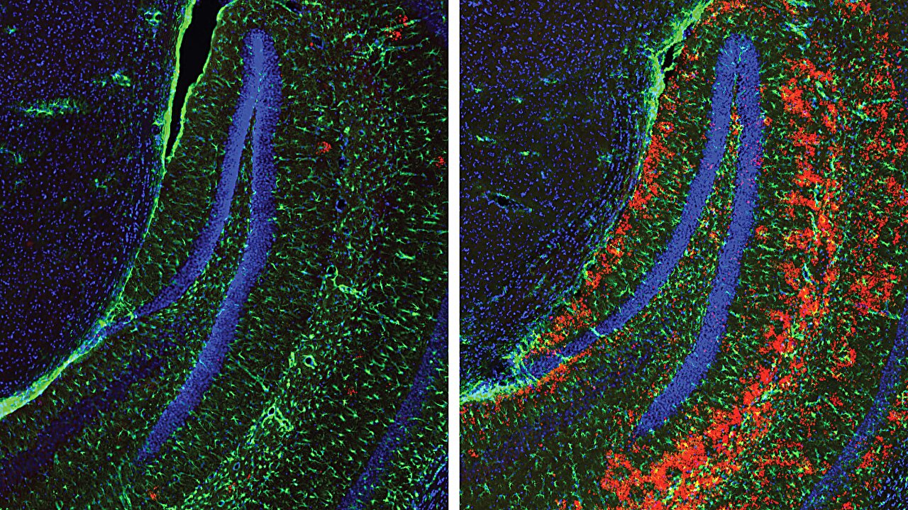 RNF213 marks abnormal glycogen for cellular disposal, study finds