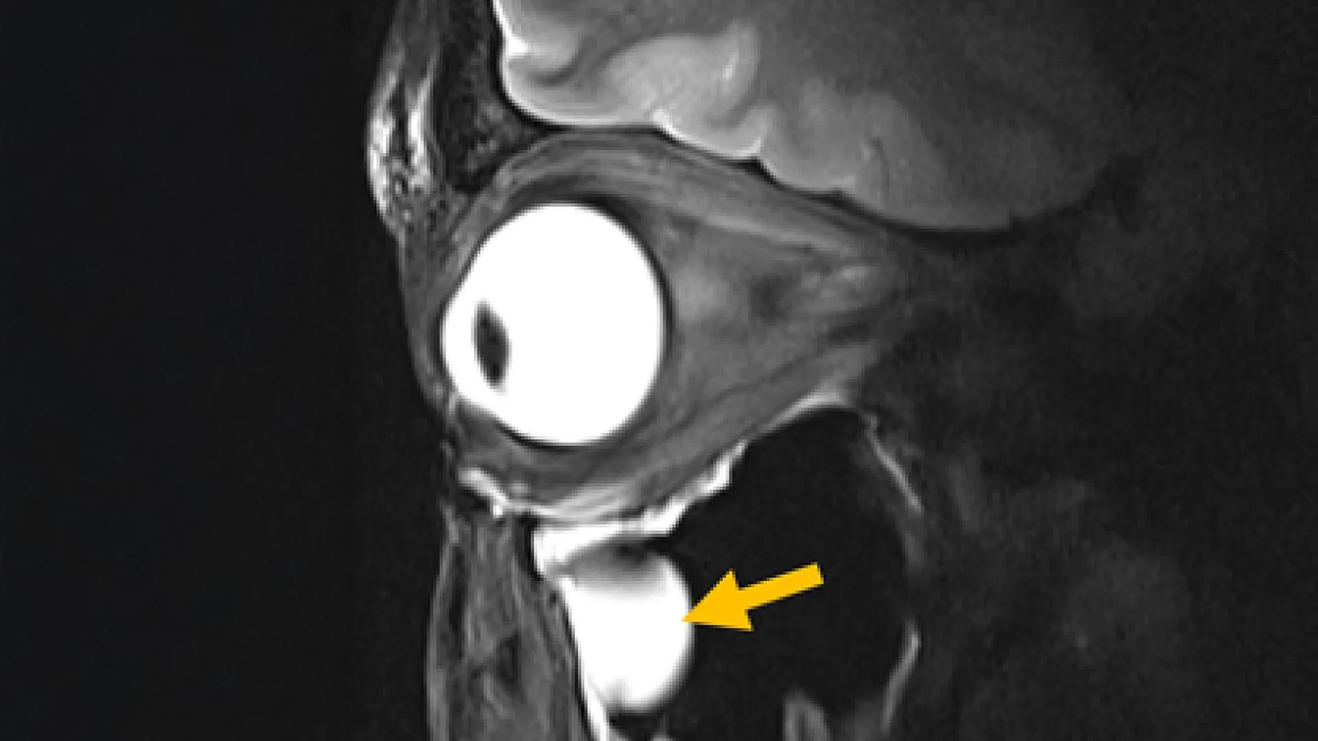 New MRI antenna sharpens images of the eye and deep brain