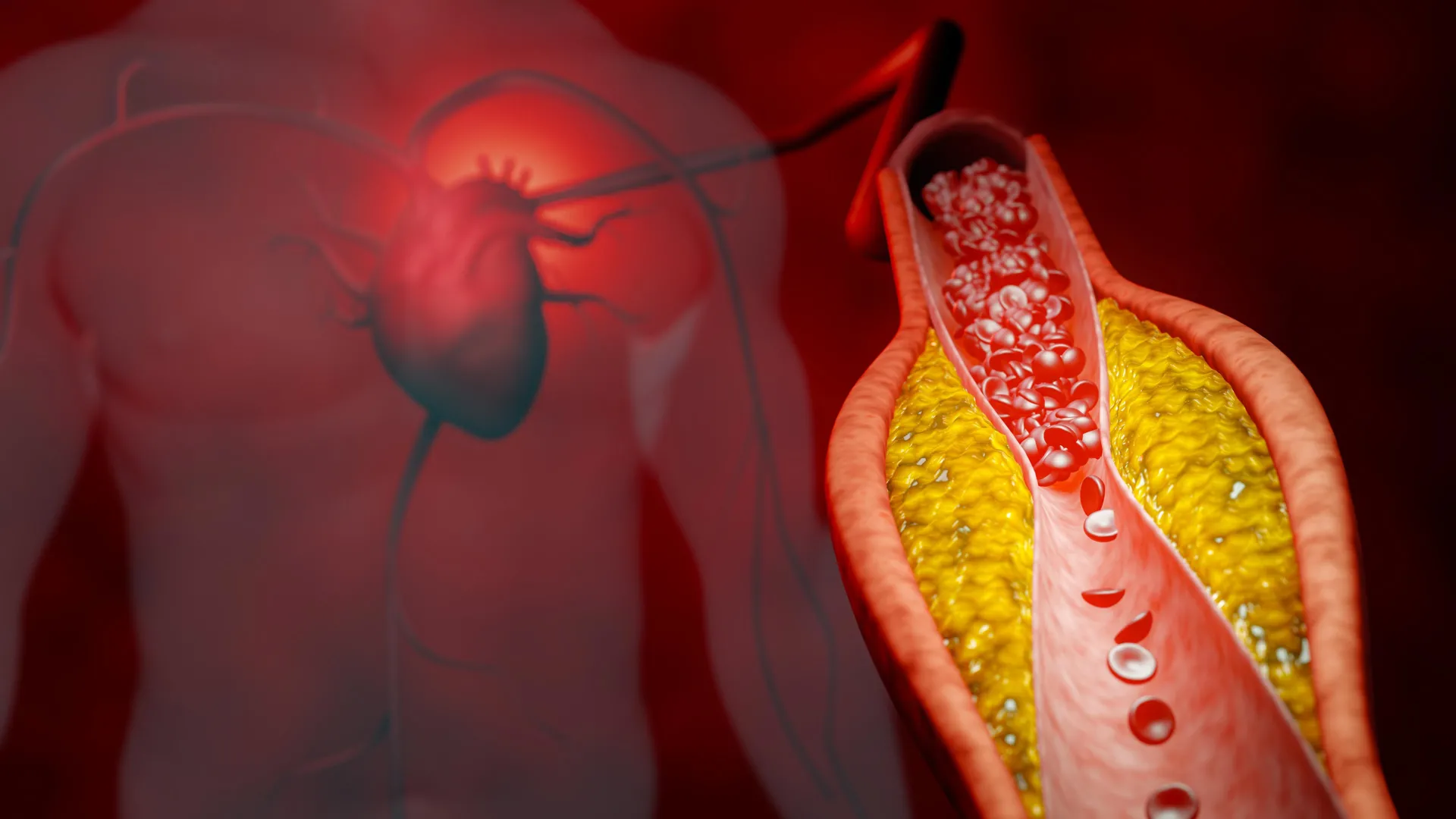 ApoB test may better guide cholesterol treatment, study finds