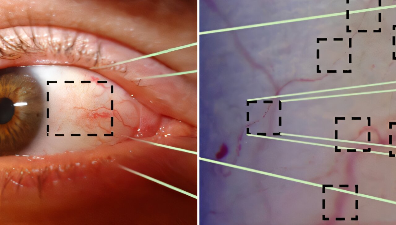 AI eye-video system shows promise for anemia screening without needles