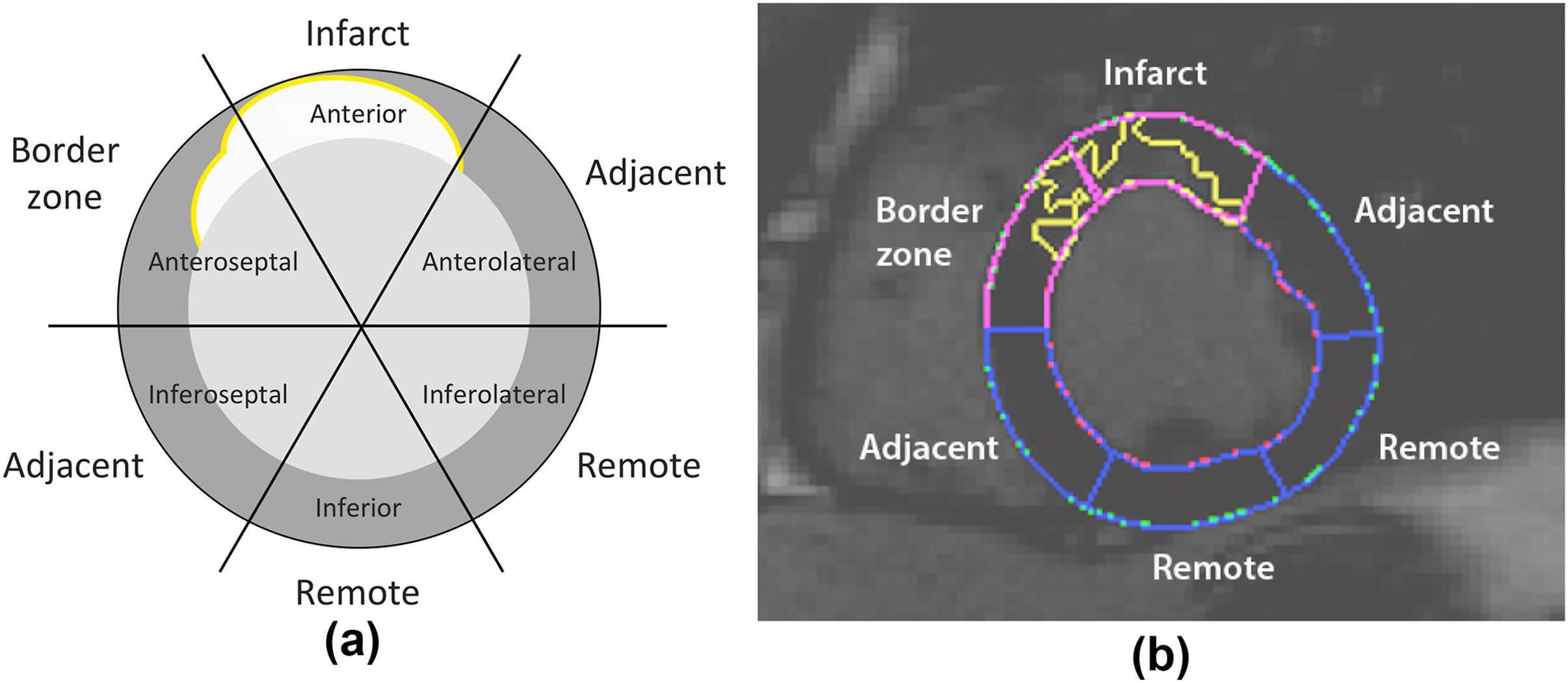 MRI analysis may detect heart attack effects beyond scarred tissue