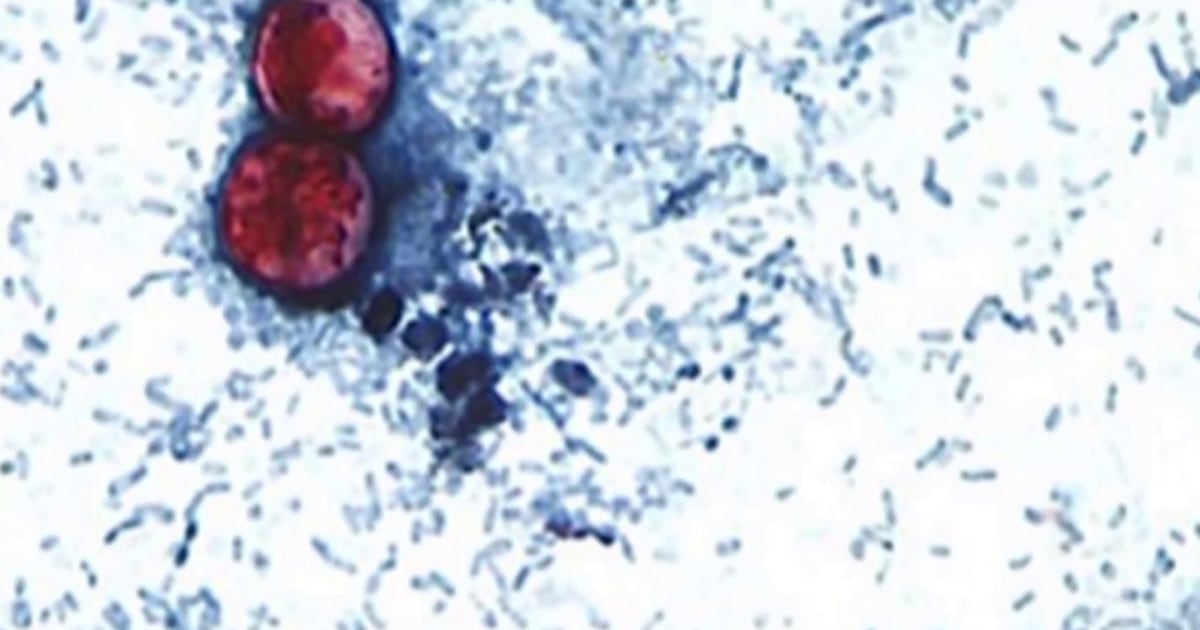 Cyclosporiasis cases rise in several states as FDA investigates
