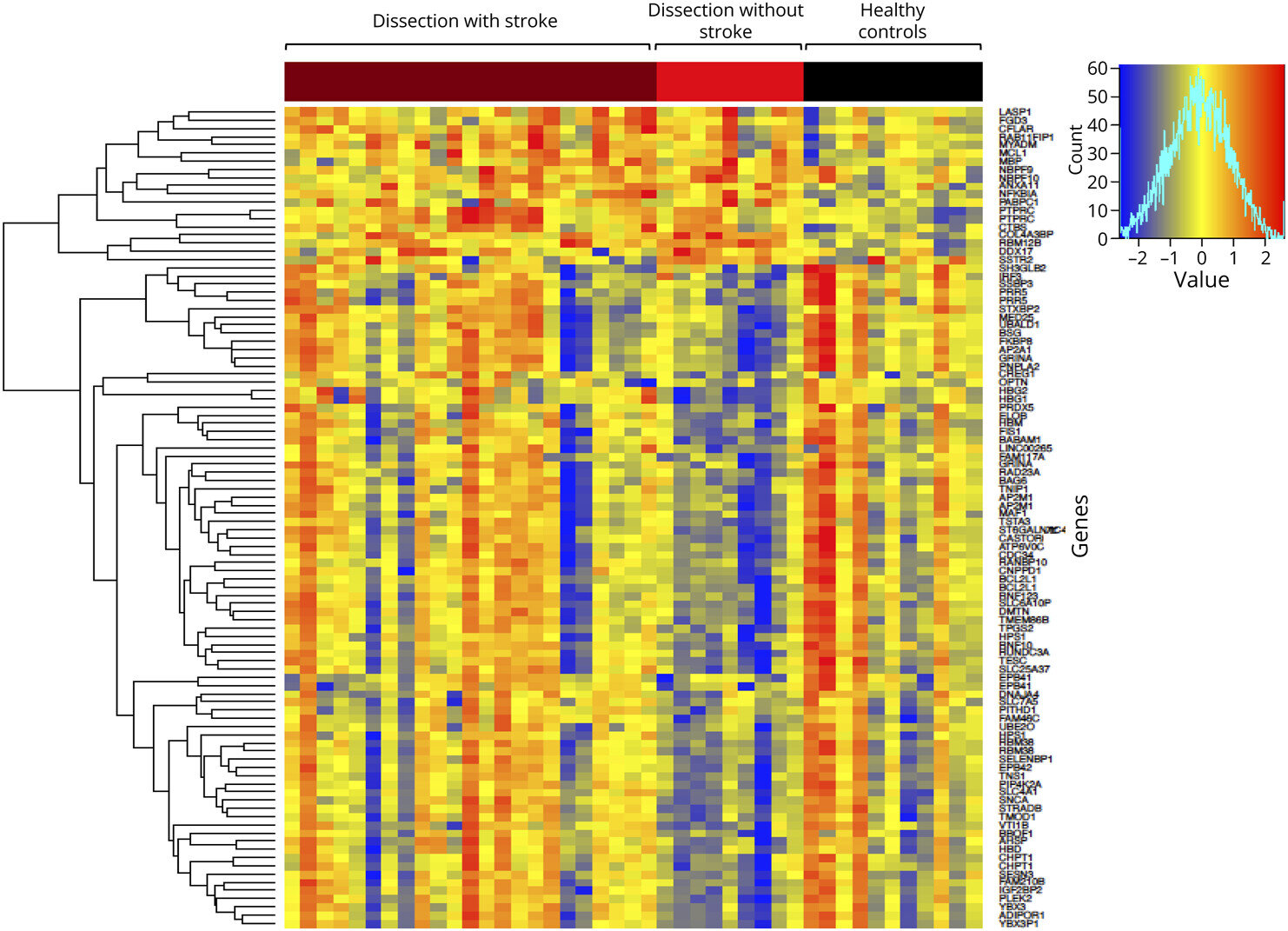 Study finds temporary gene pattern tied to artery tears in young stroke patients