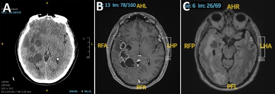 Spanish patient’s brain lesions traced to pork tapeworm larvae