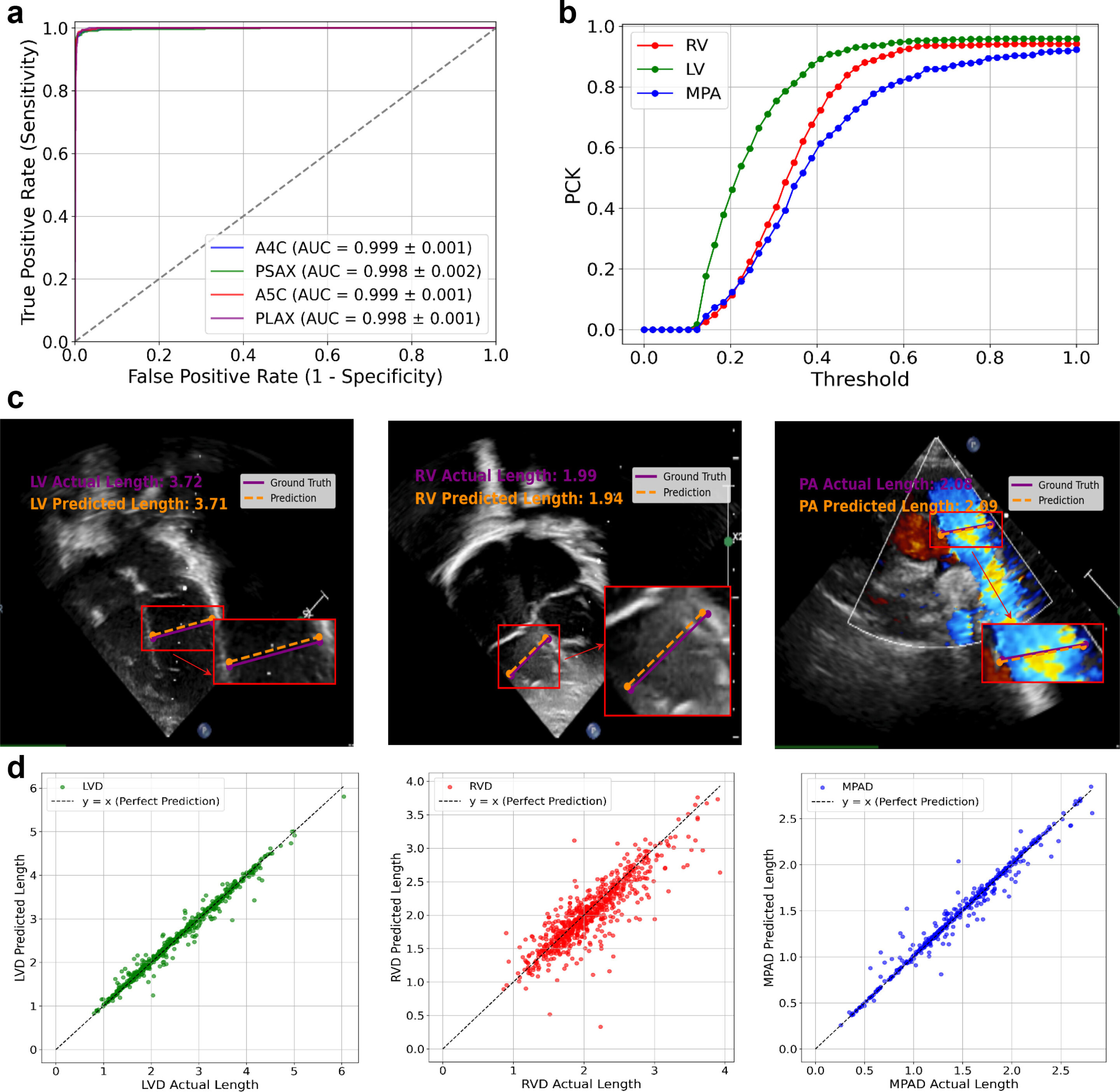 AI framework aims to aid care for children with tetralogy of Fallot