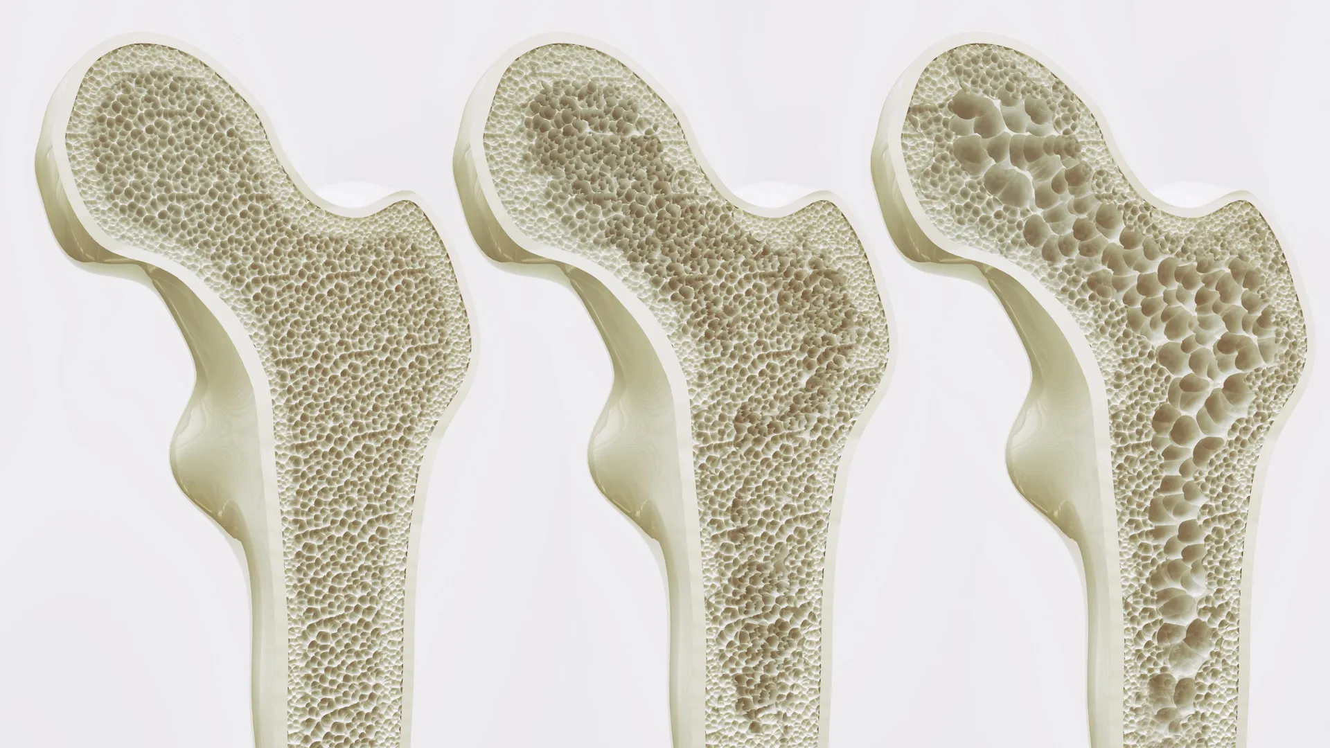 Semaglutide tied to lower fracture risk in diabetes study