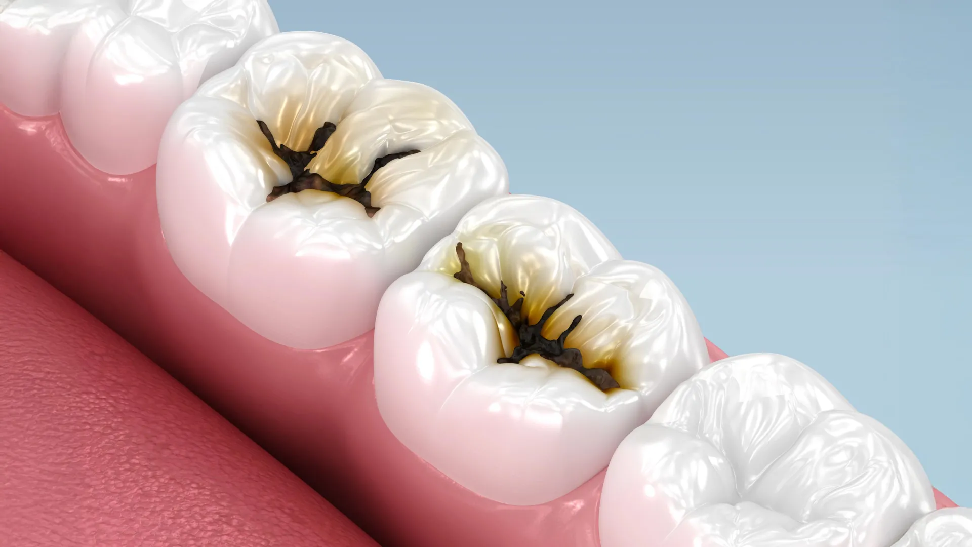 Silver diamine fluoride for cavities stops decay in U.S. trial