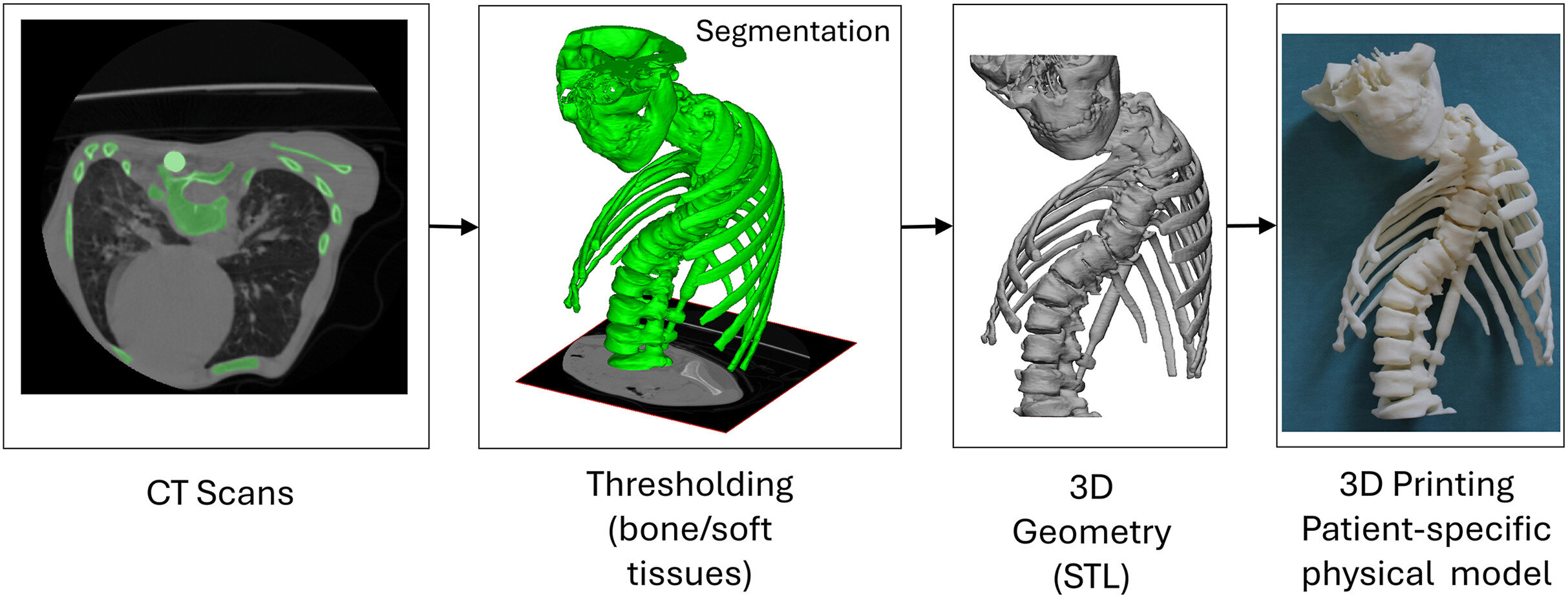 3D-printed spine models may aid planning for complex operations